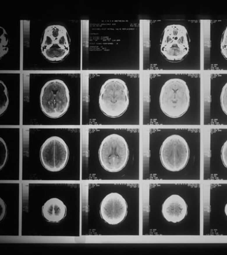 Traumatic Brain & Head Injury Lawyers - Brain Scans